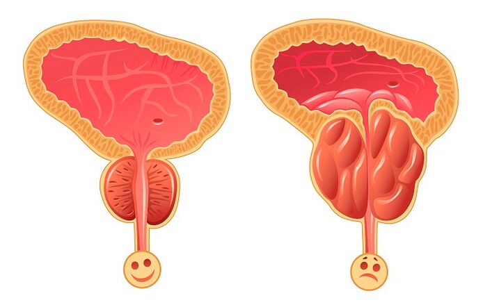 Нормална и възпалена простата