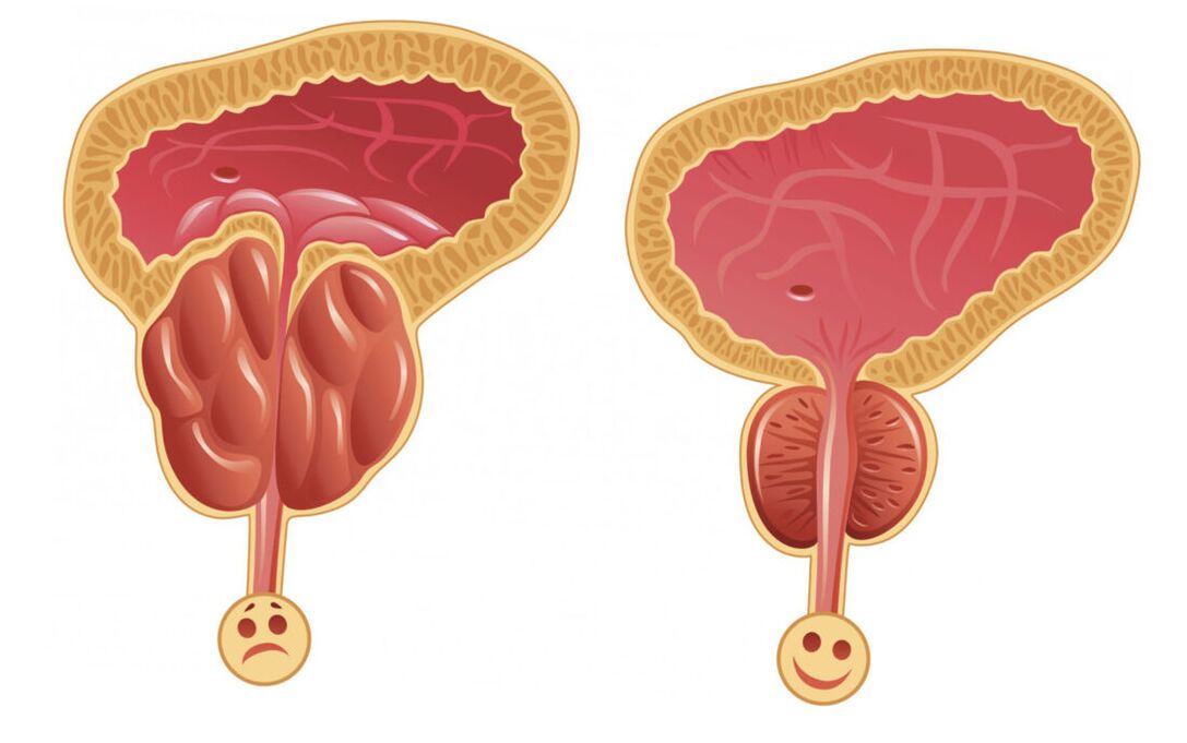 Възпаление на простатата с простатит (вляво) и простатната жлеза е нормална (вдясно)